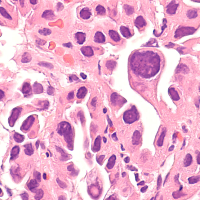 Lung cancer under microscope — coverage from STAT