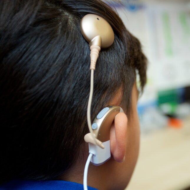 A child with black short hairs wears a cochlear implant on their head — coverage from STAT