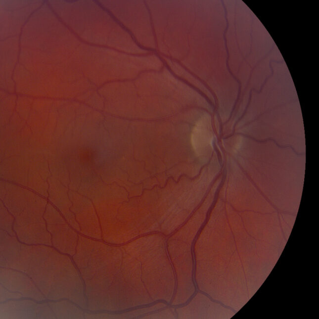 A congested optic disc — biotech coverage from STAT